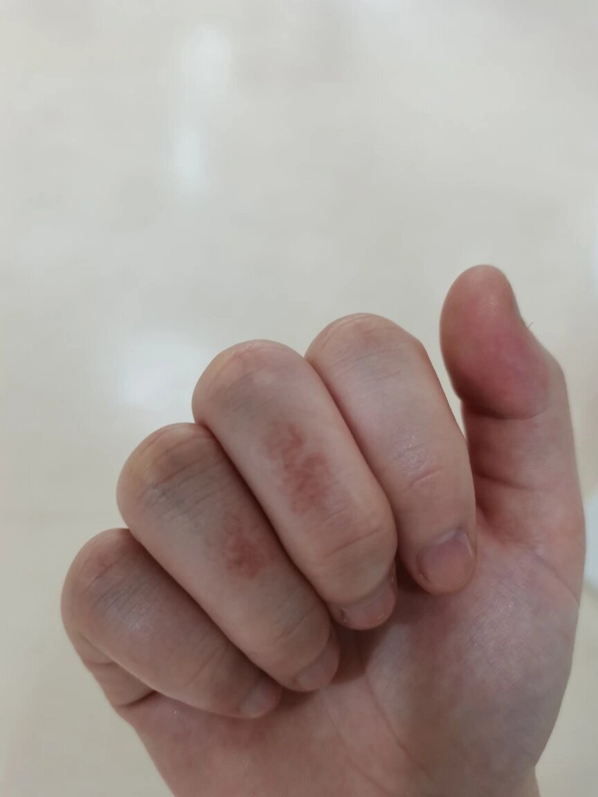 洗衣服被84消毒液灼伤手 昨天晚上一个白短裤被弄上了污渍,后来买了一