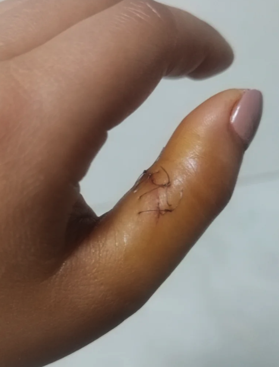 缝针的伤口通常可以通过飞机安检