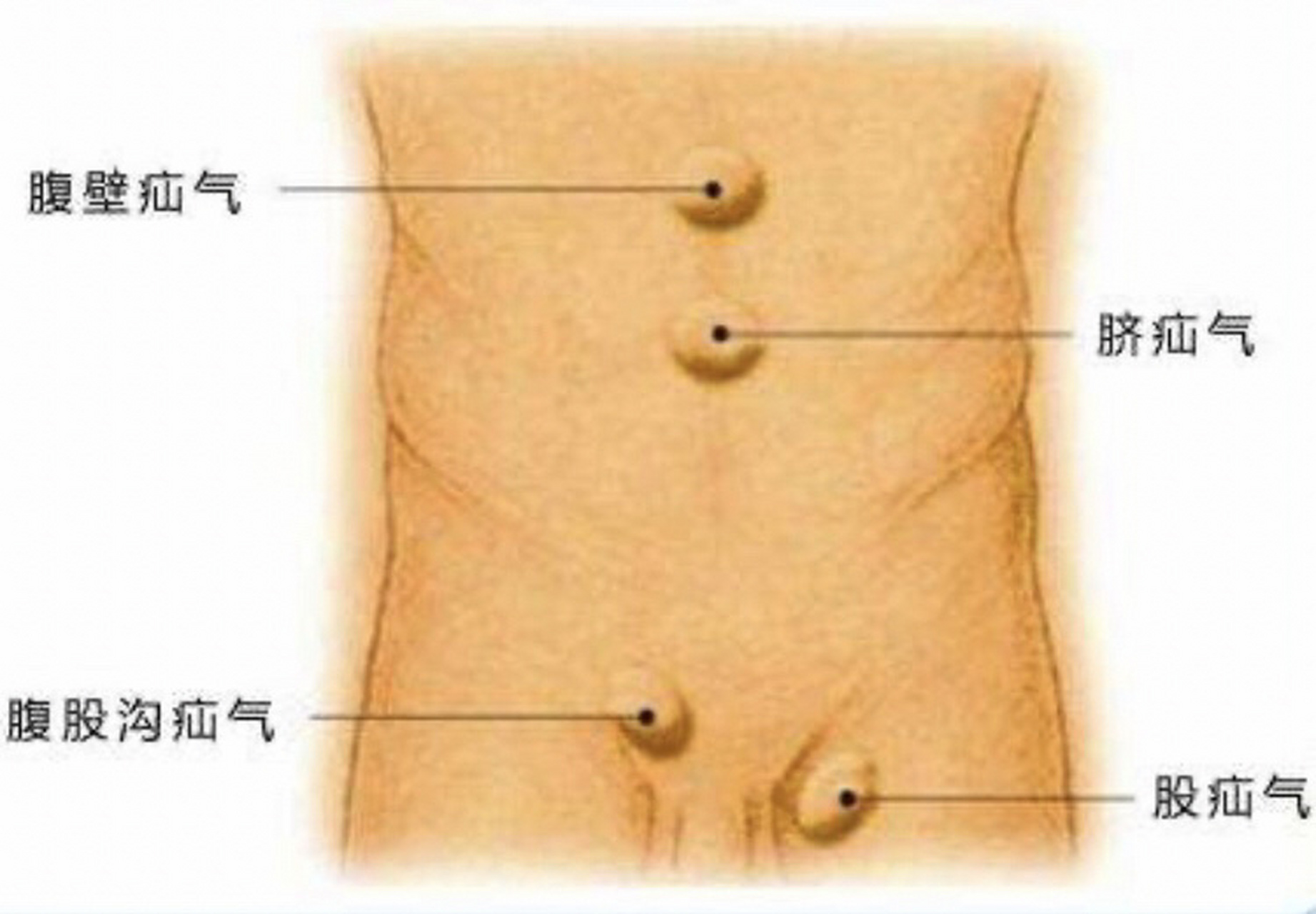 腹股沟疝气(上) 11566发现疝气: 孩子在十几个月的时候发现疝气