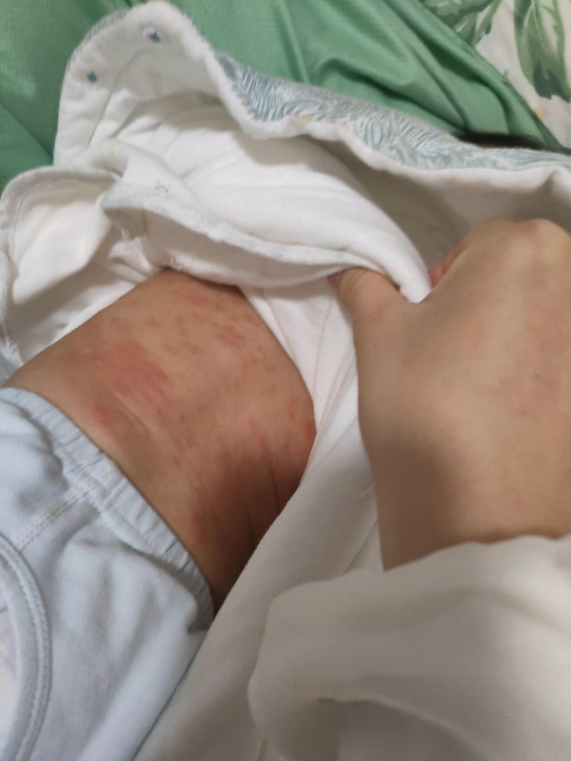 自从长了干性湿疹后,后背又出现这样一片一片的红疹子,反反复复好了