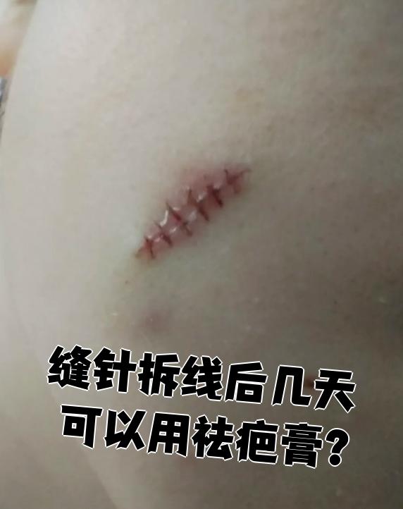 缝针拆线后几天可以用祛疤膏?