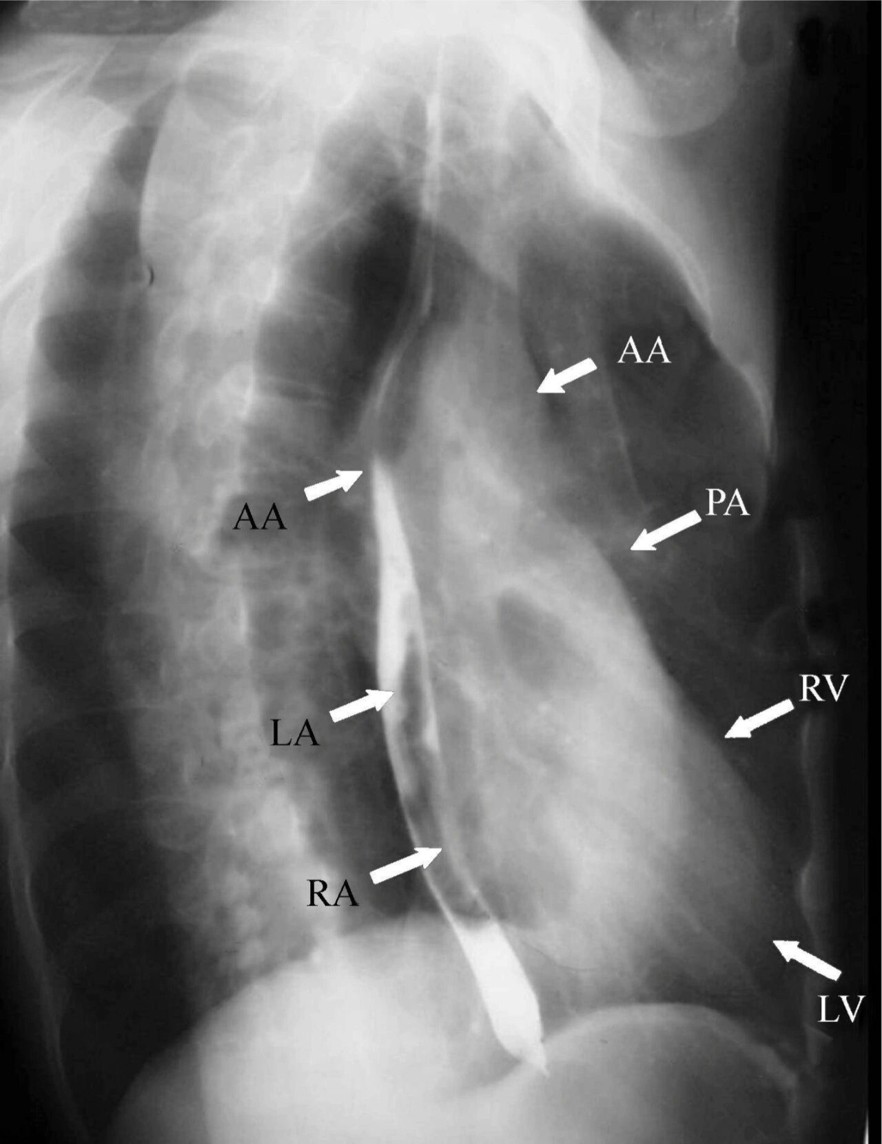x线读片指南(1) 正常心脏x线摄片各体位影像特点 (图1)svc—上腔静脉
