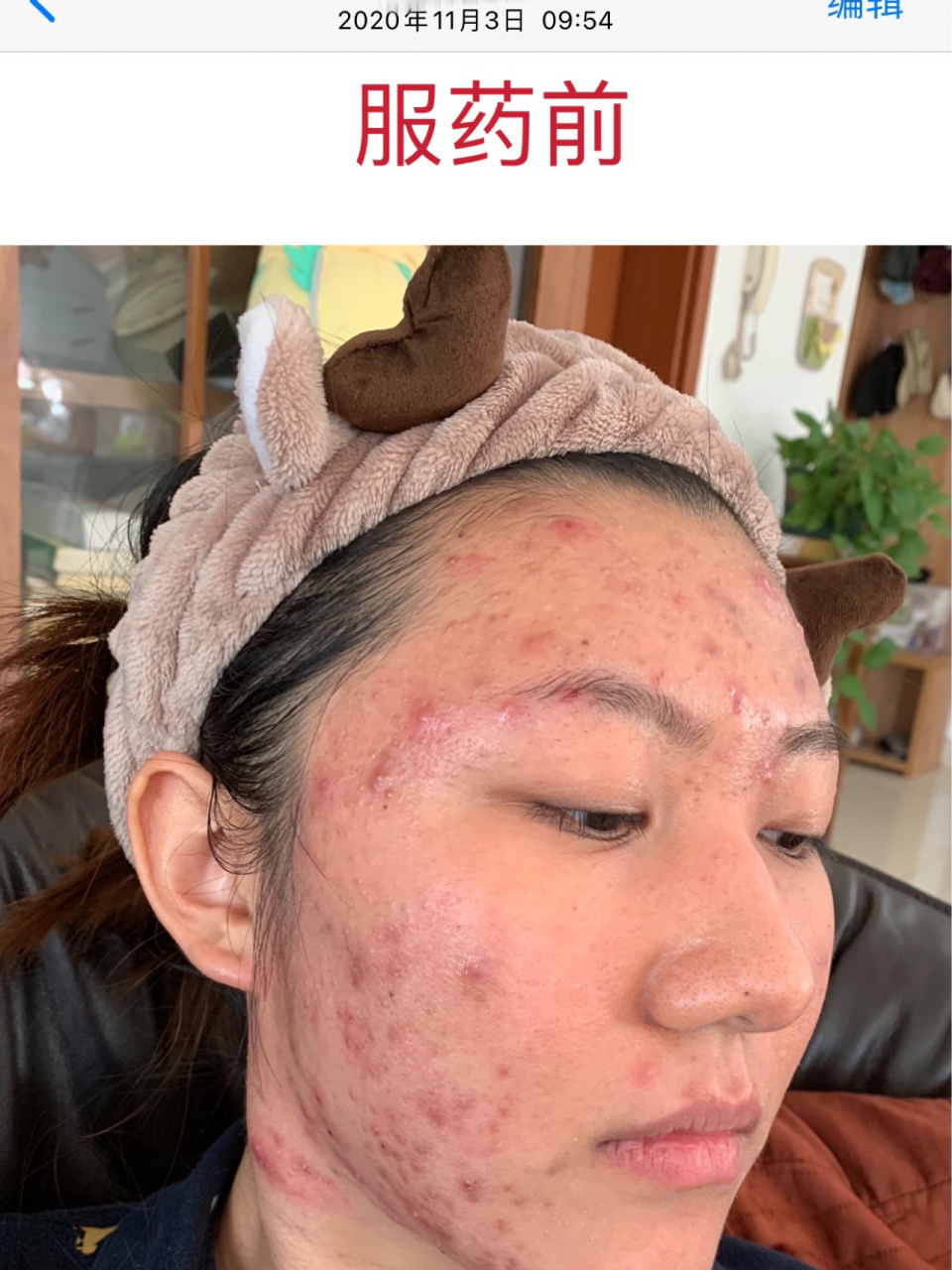 泰尔丝 异维a酸三个月全记录 异维a酸用药三个月了,决定把三个月脸部