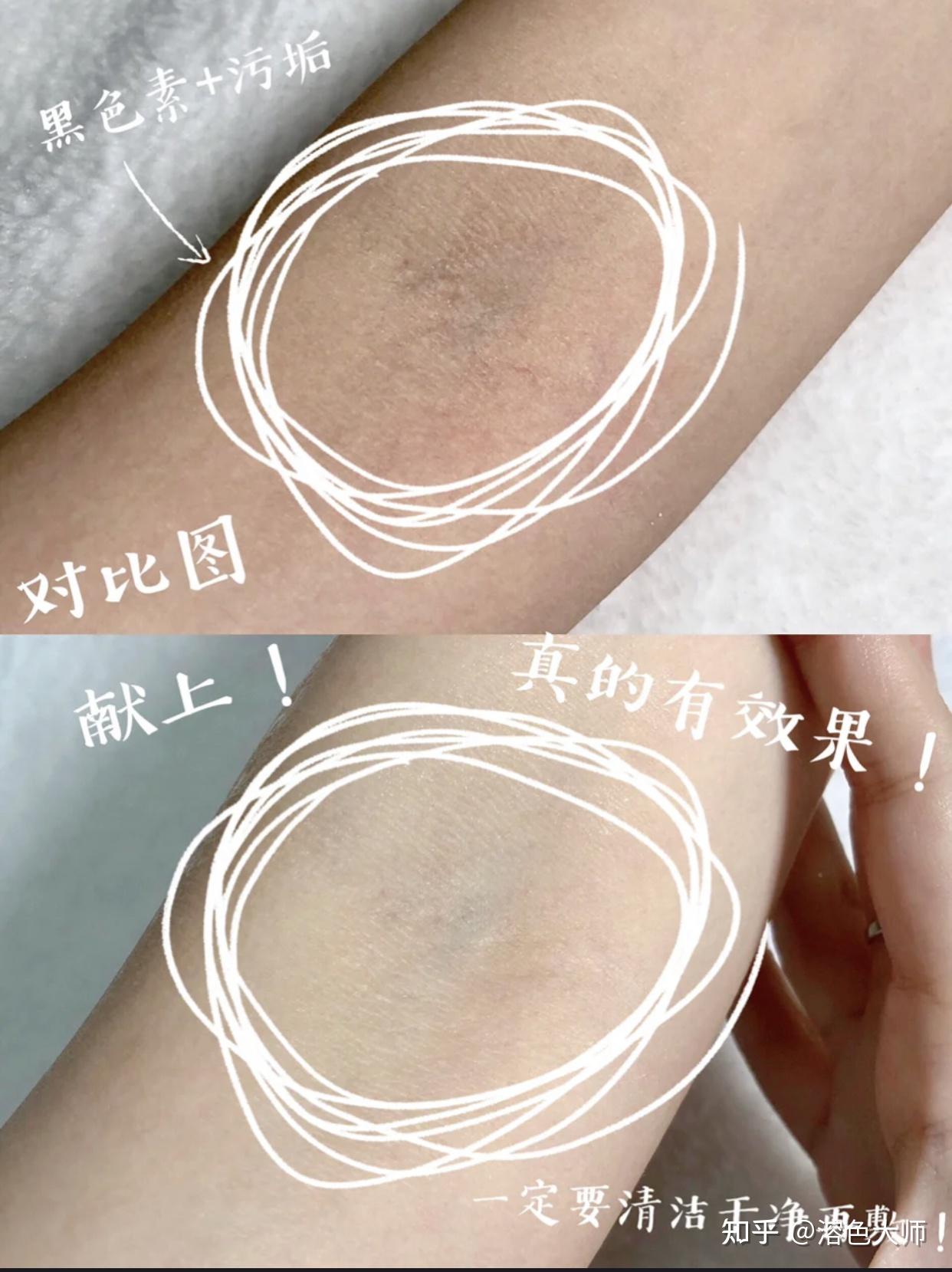 想了解下关节黑色素沉淀怎么去除