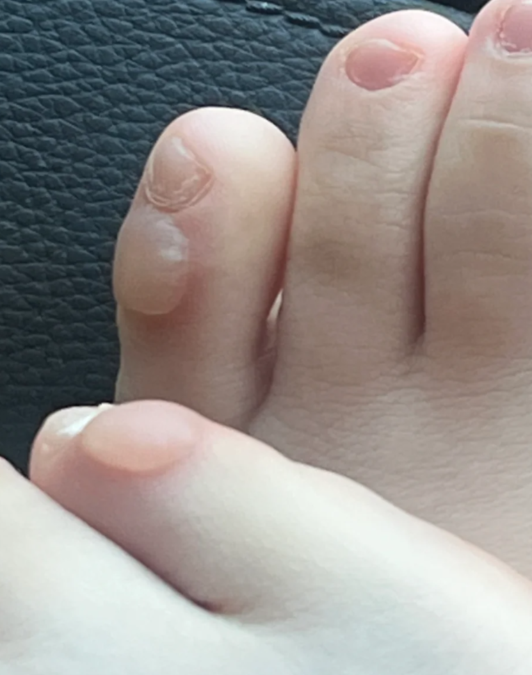 脚上长水泡最常见的原因是足癣或者摩擦受压