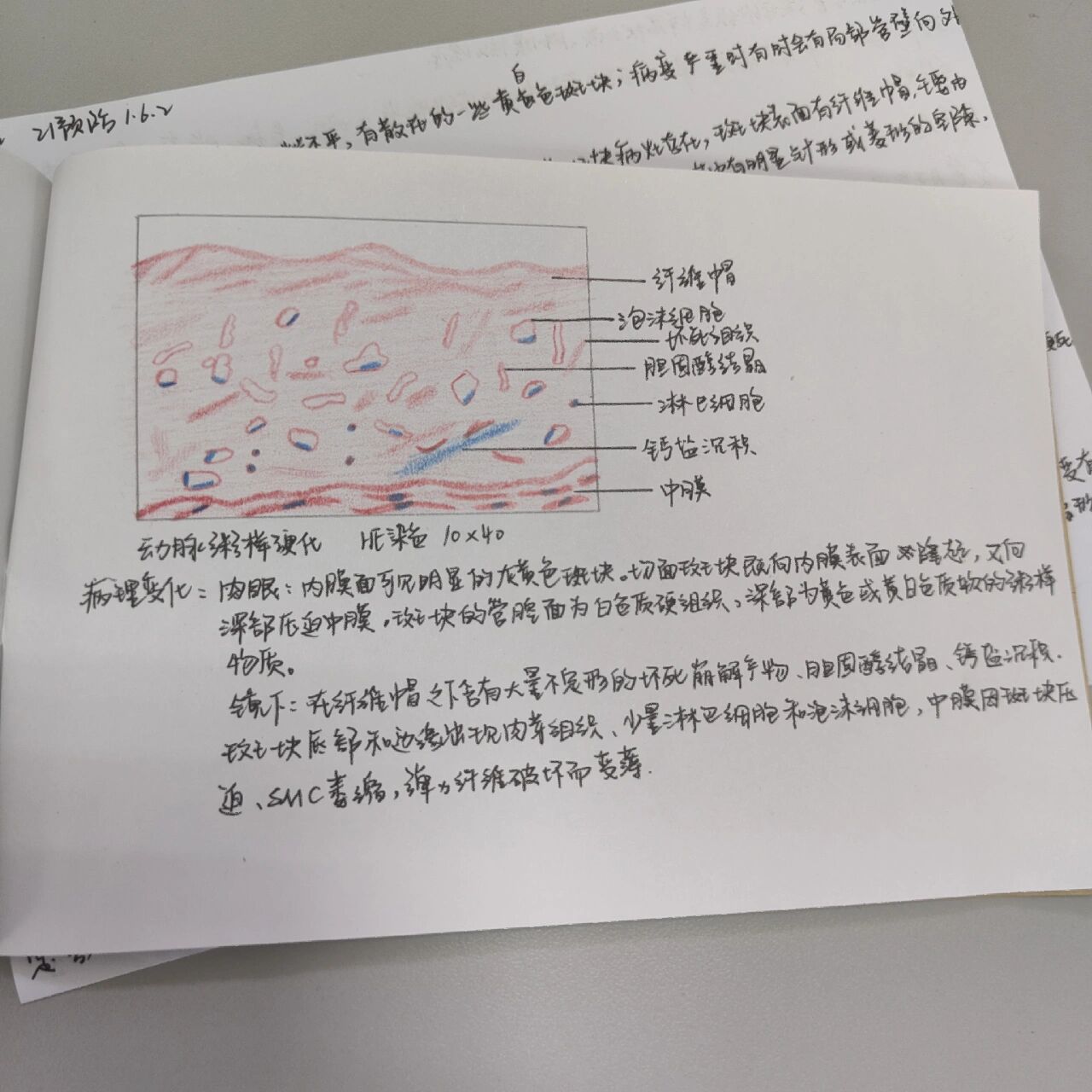 动脉粥样硬化切片图解图片