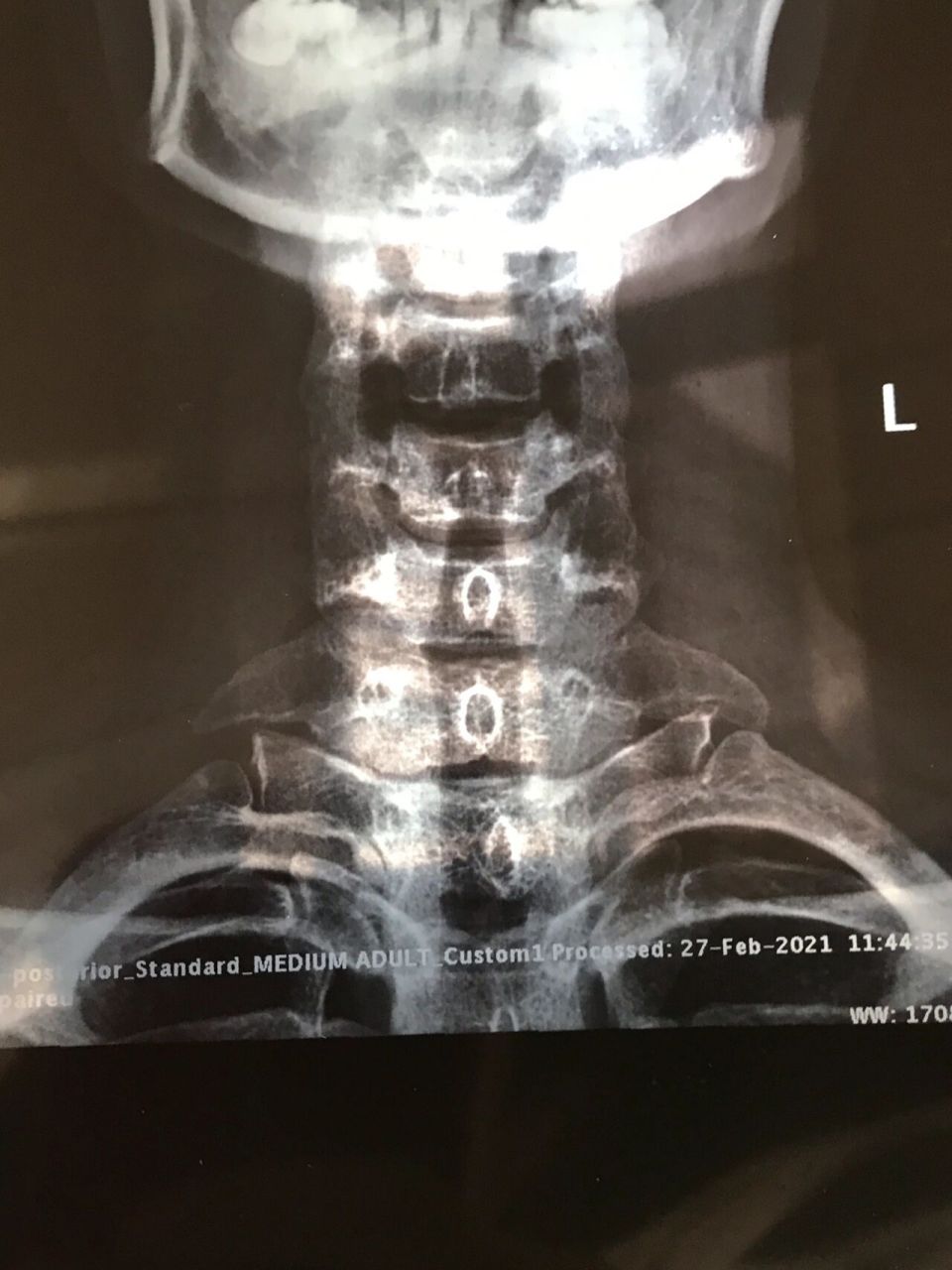 想知道有颈肋(颈椎第七节横突过长)有症状的人你们在哪里?