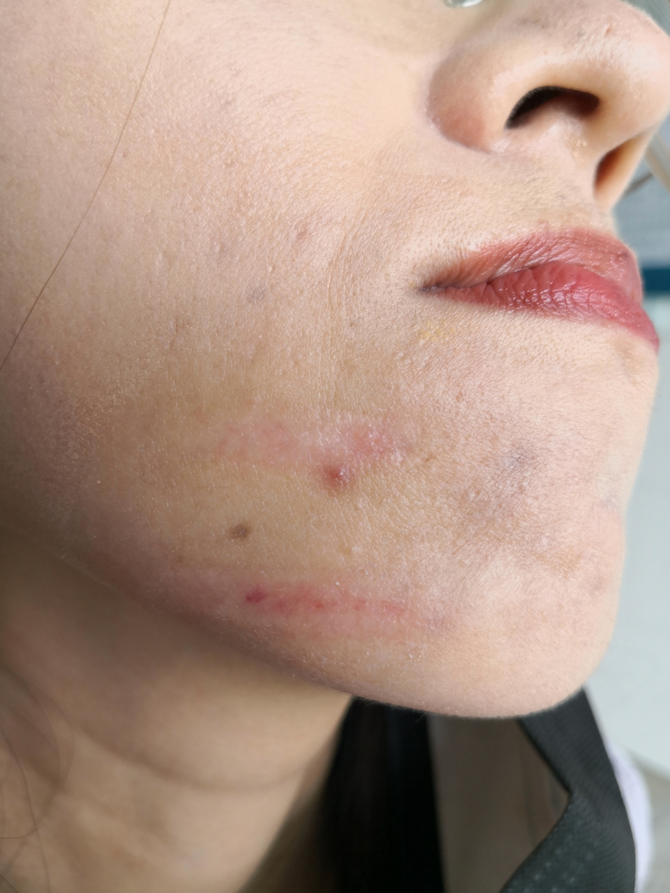 光子嫩肤烫伤后疤痕.恢复期症状.#解决皮肤问题专注皮肤美容##疤痕