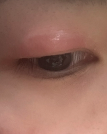 上眼皮肿了个包常见原因有麦粒肿,结膜炎或蚊虫叮咬,不同情况处理