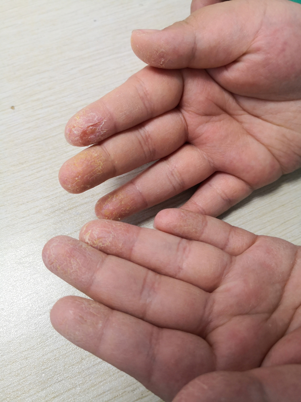 手指汗疱疹 治疗方法图片