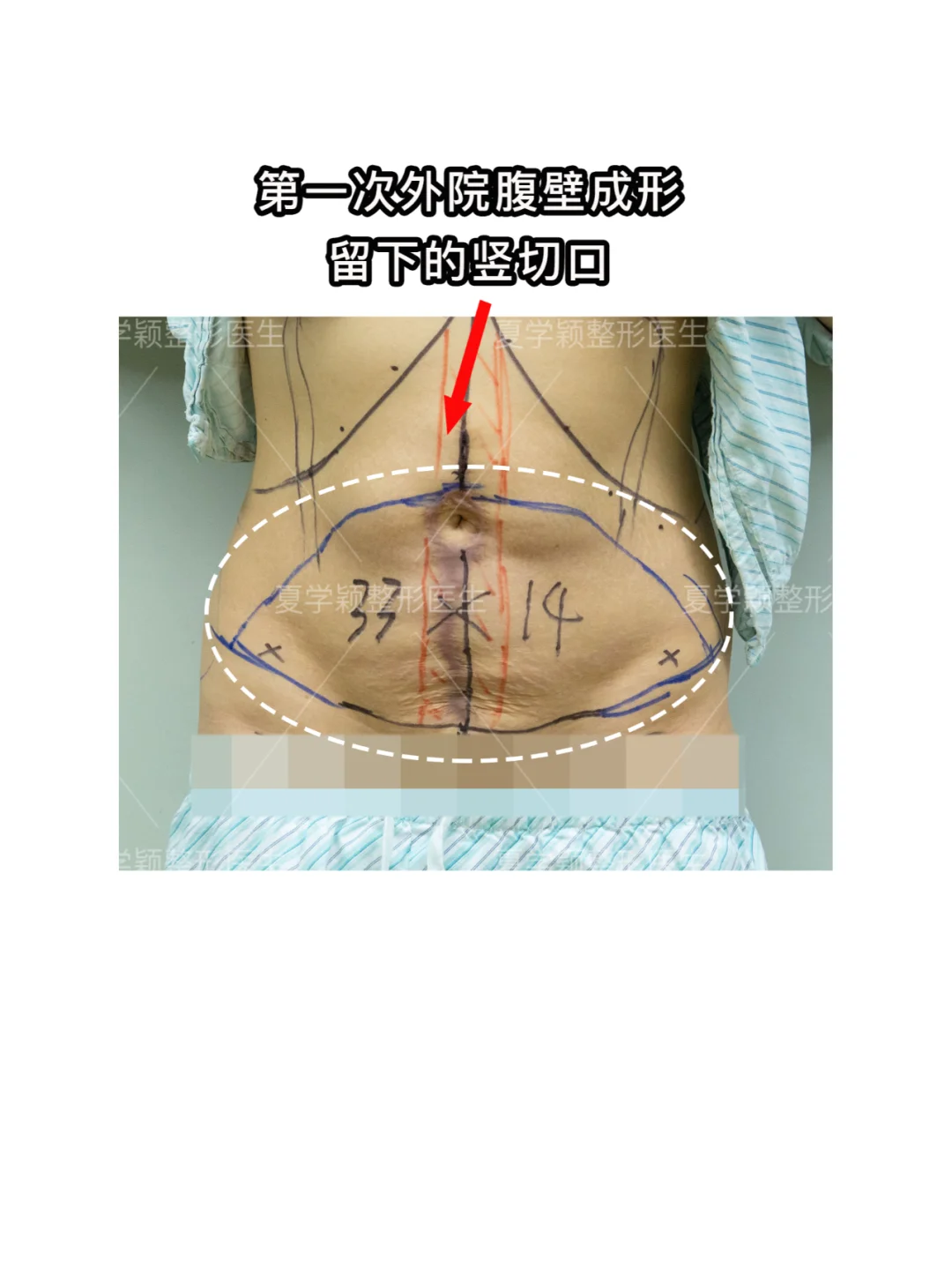 腹壁成形9个月反馈