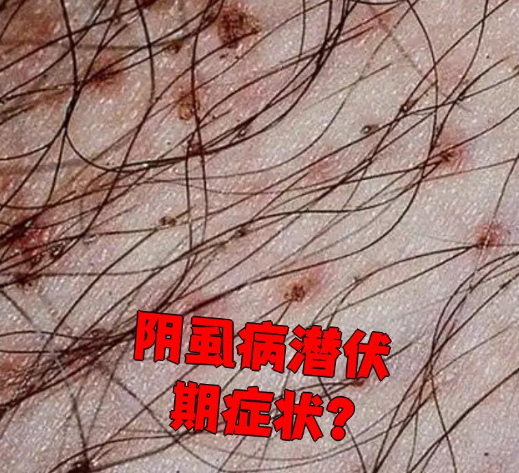 阴虱病潜伏期症状?