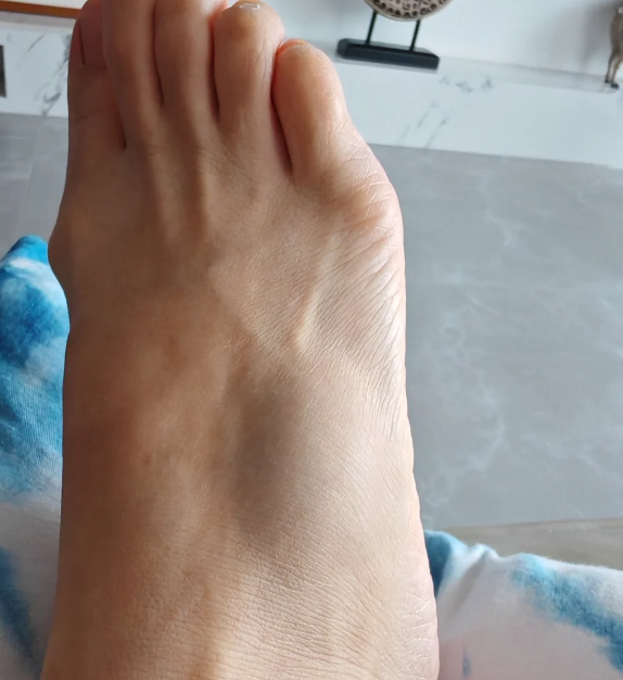 脚外侧中间骨头突出可能是正常现象,也可能是受伤或生病引起的,歇要