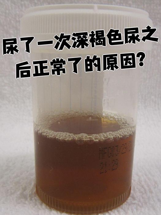 深褐色尿出现一次后恢复正常,最常见的原因是尿液暂时性浓缩