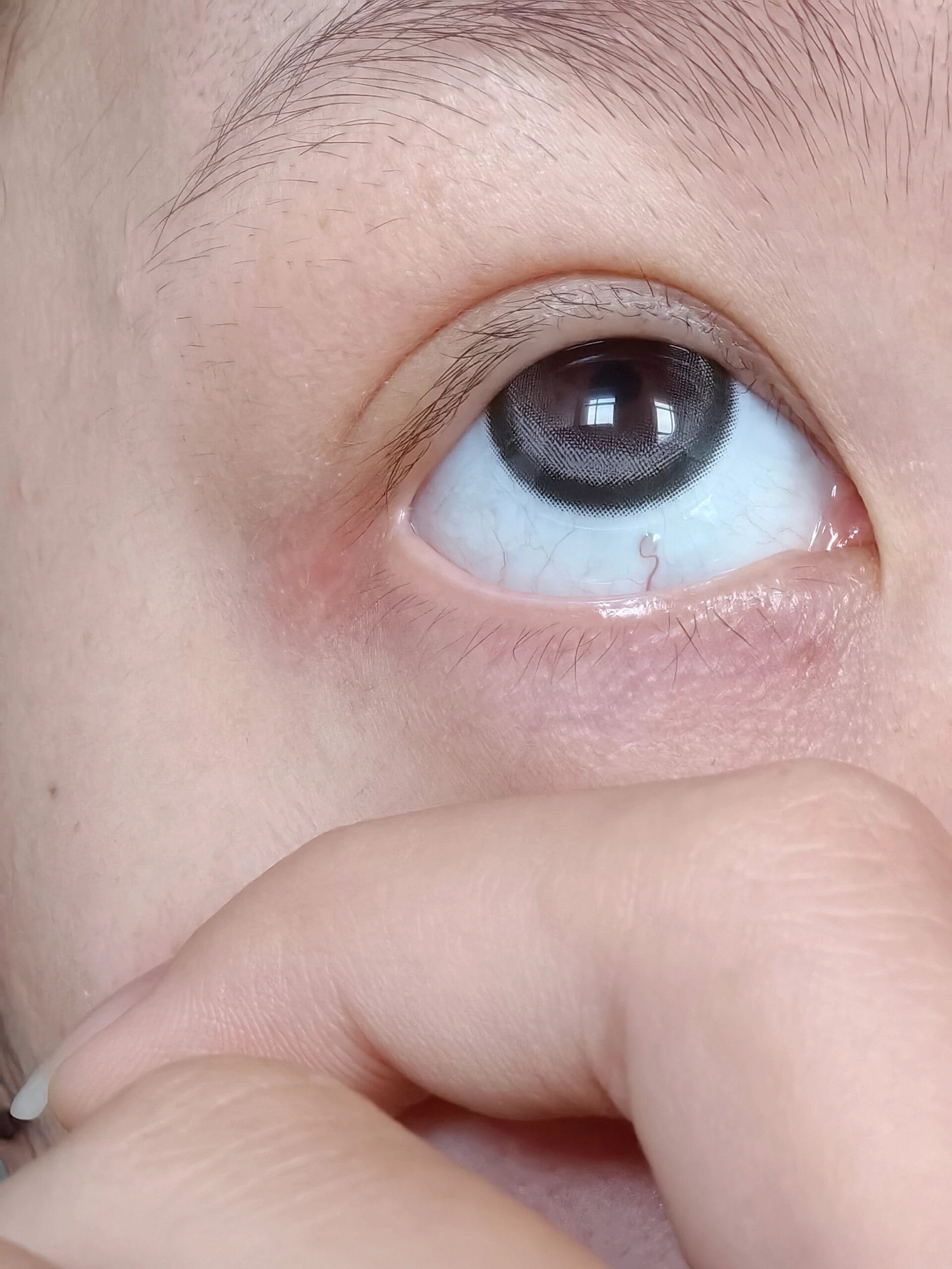 眼球上有一个透明水泡