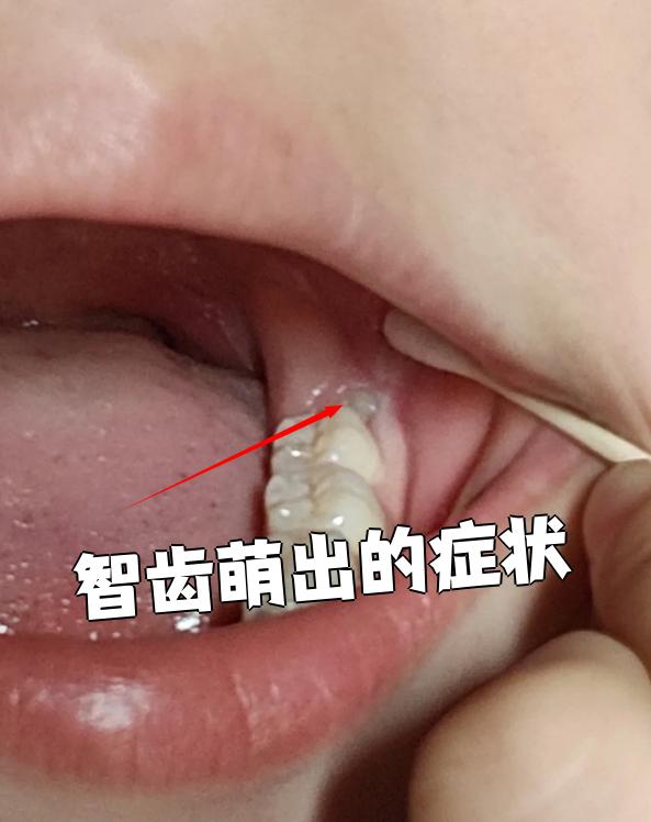 智齿萌出是正常现象,如果位置正确且没有引发炎症