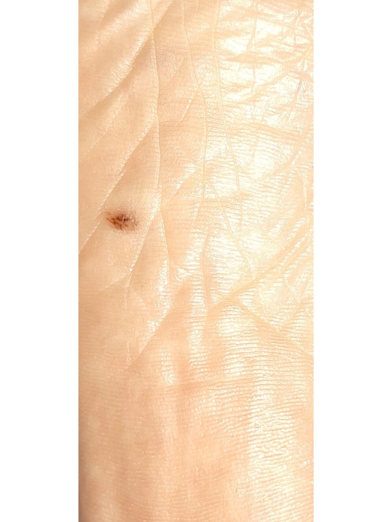 观察了很久的足底痣