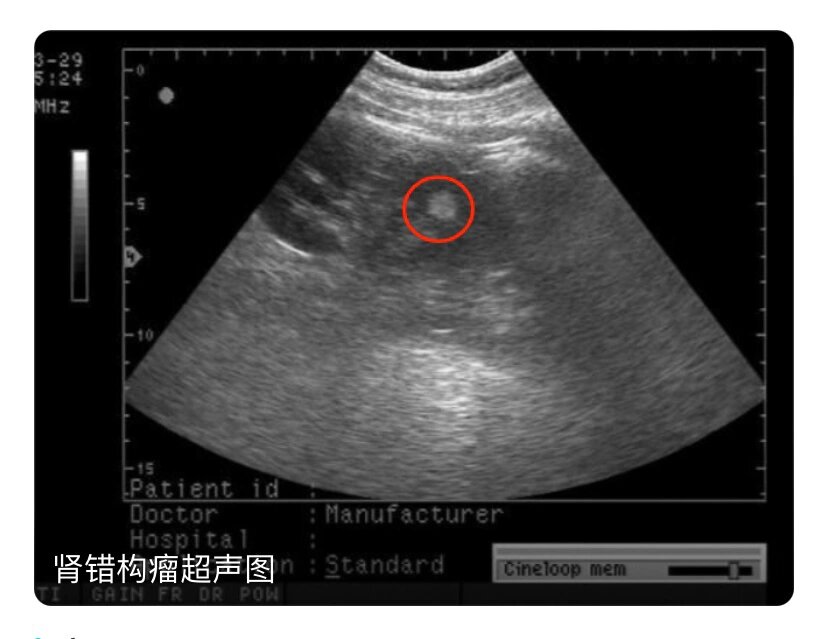 右肾错构瘤图片