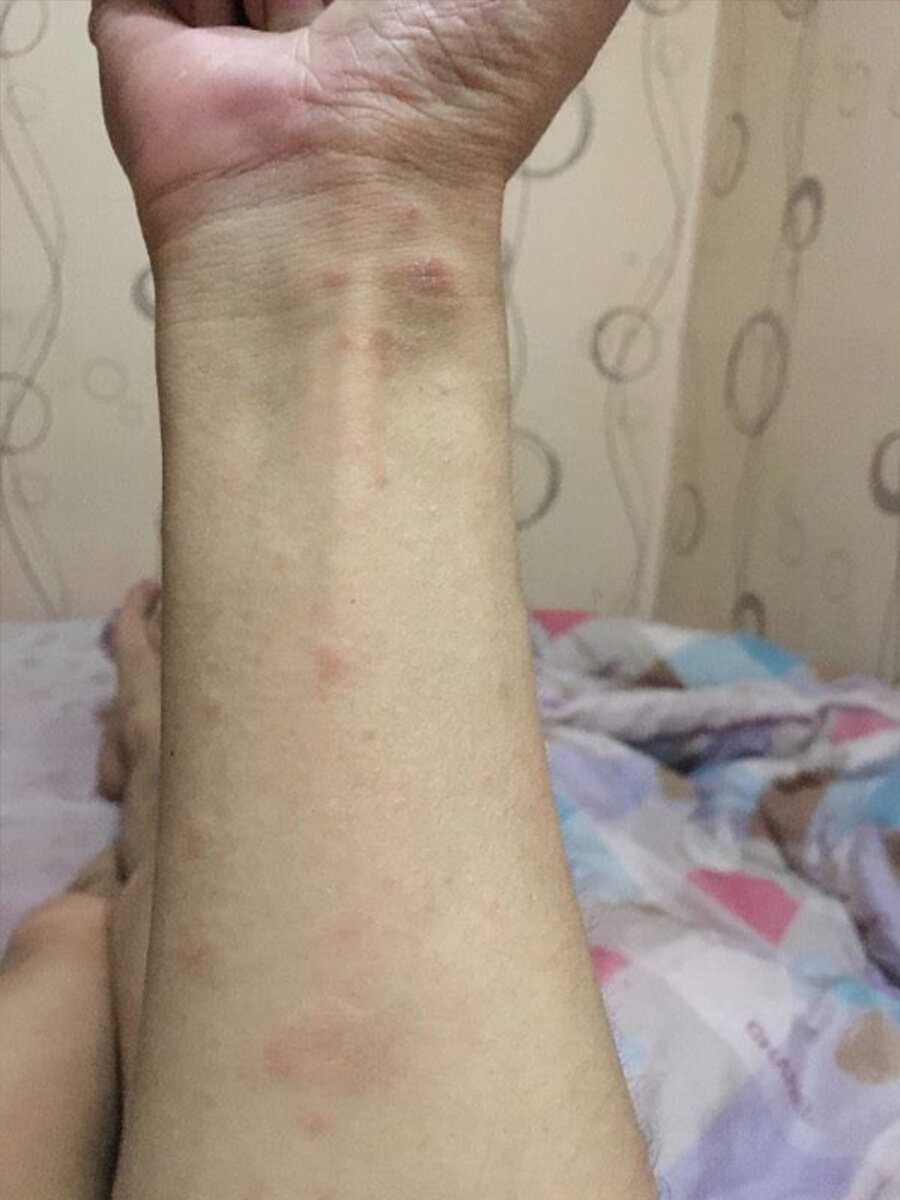 小水泡  有一段时间胳膊上面老是莫名其妙的长出很