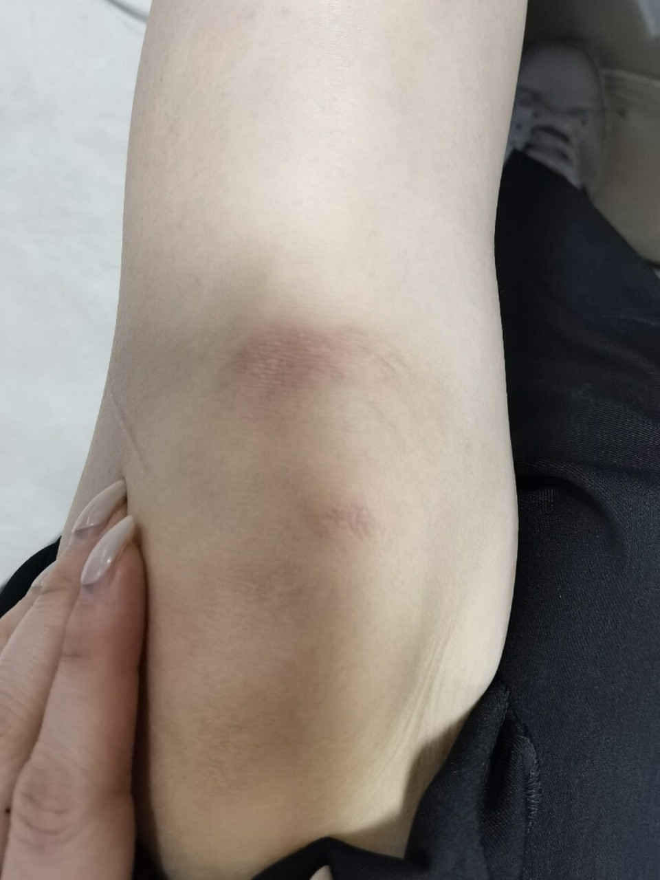 膝盖摔伤 很多人问我膝盖摔伤现在恢复成什么样子了,黑色沉淀肯定还是