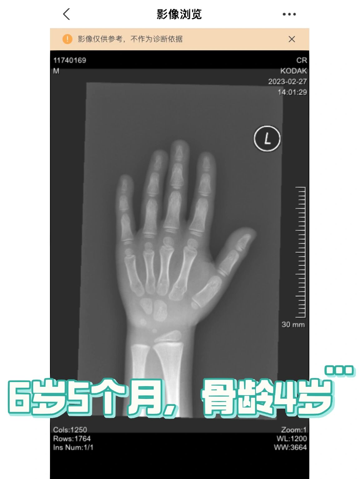 6岁5个月骨龄4岁要不要打生长激素?