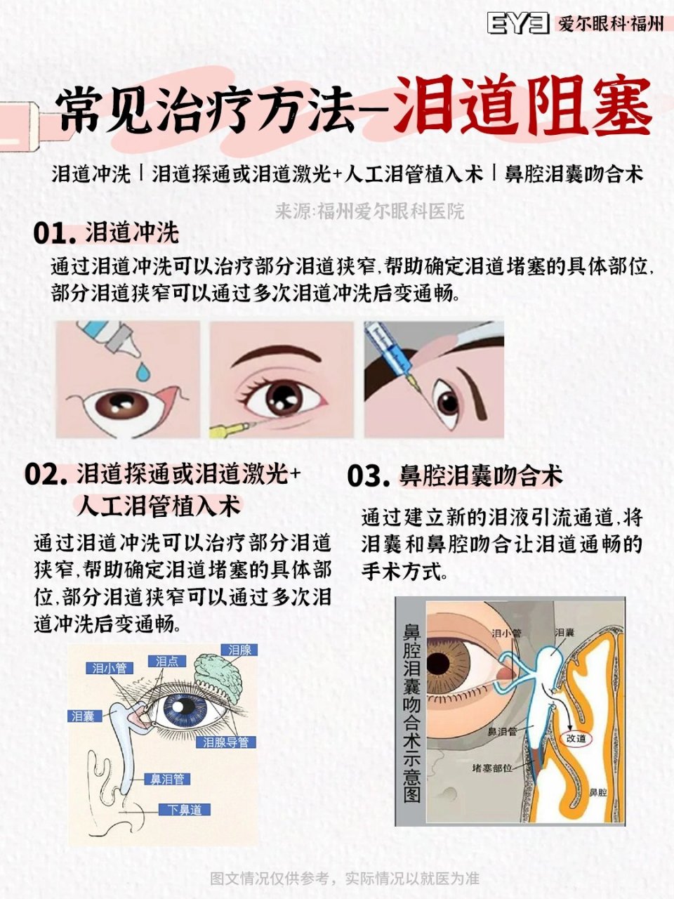 泪管按摩手法图片