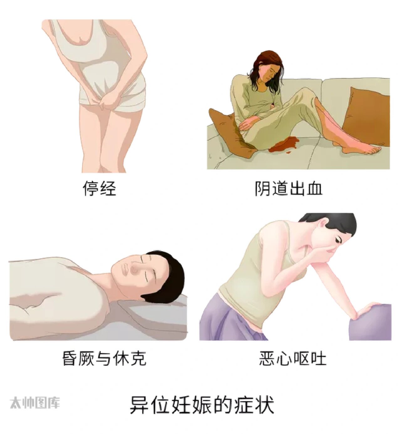 图解妇产科:异位妊娠 异位妊娠的类型 受精卵种植在子宫体部宫腔以外