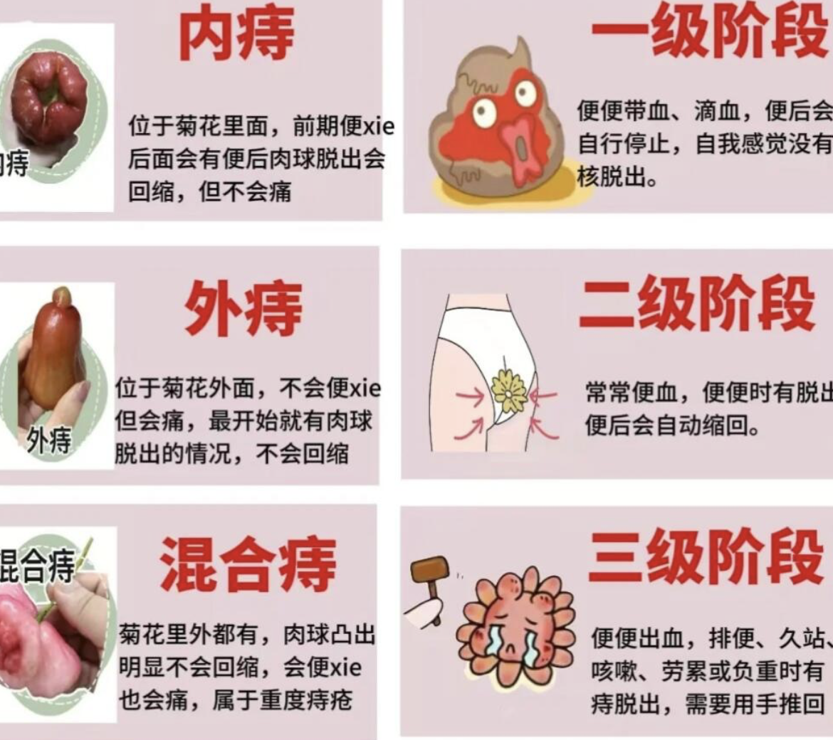 痔疮通常指的是痔