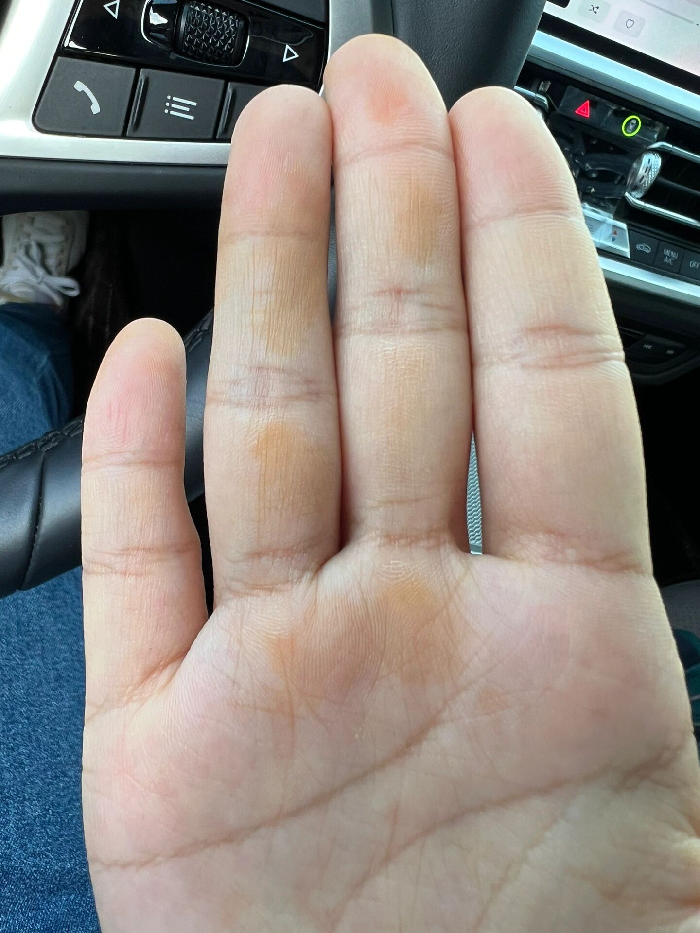 手心手指突然有黄色块块是肿么回事