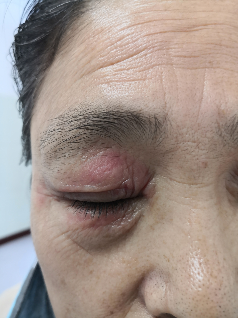 眼睑肿胀红斑干燥瘙痒症状.自行涂擦药膏引起的接触性皮炎.#过敏