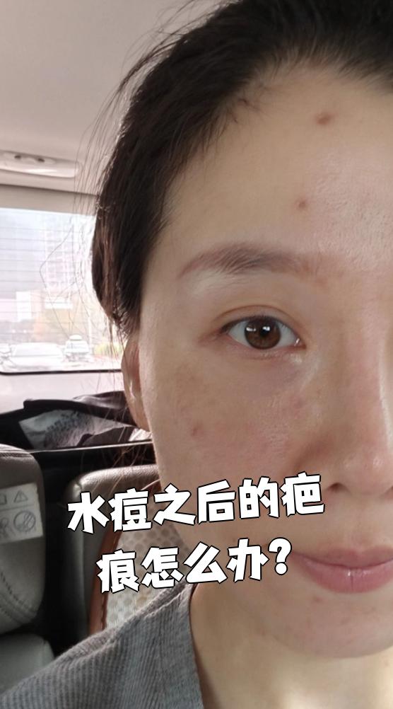 水痘之后的疤痕怎么办?