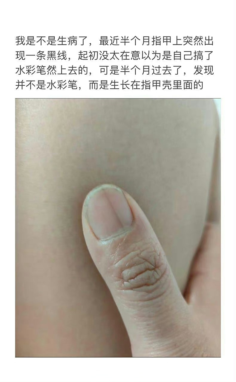 指甲上突然长了一条黑线#【#什么样的甲母痣会癌变#?