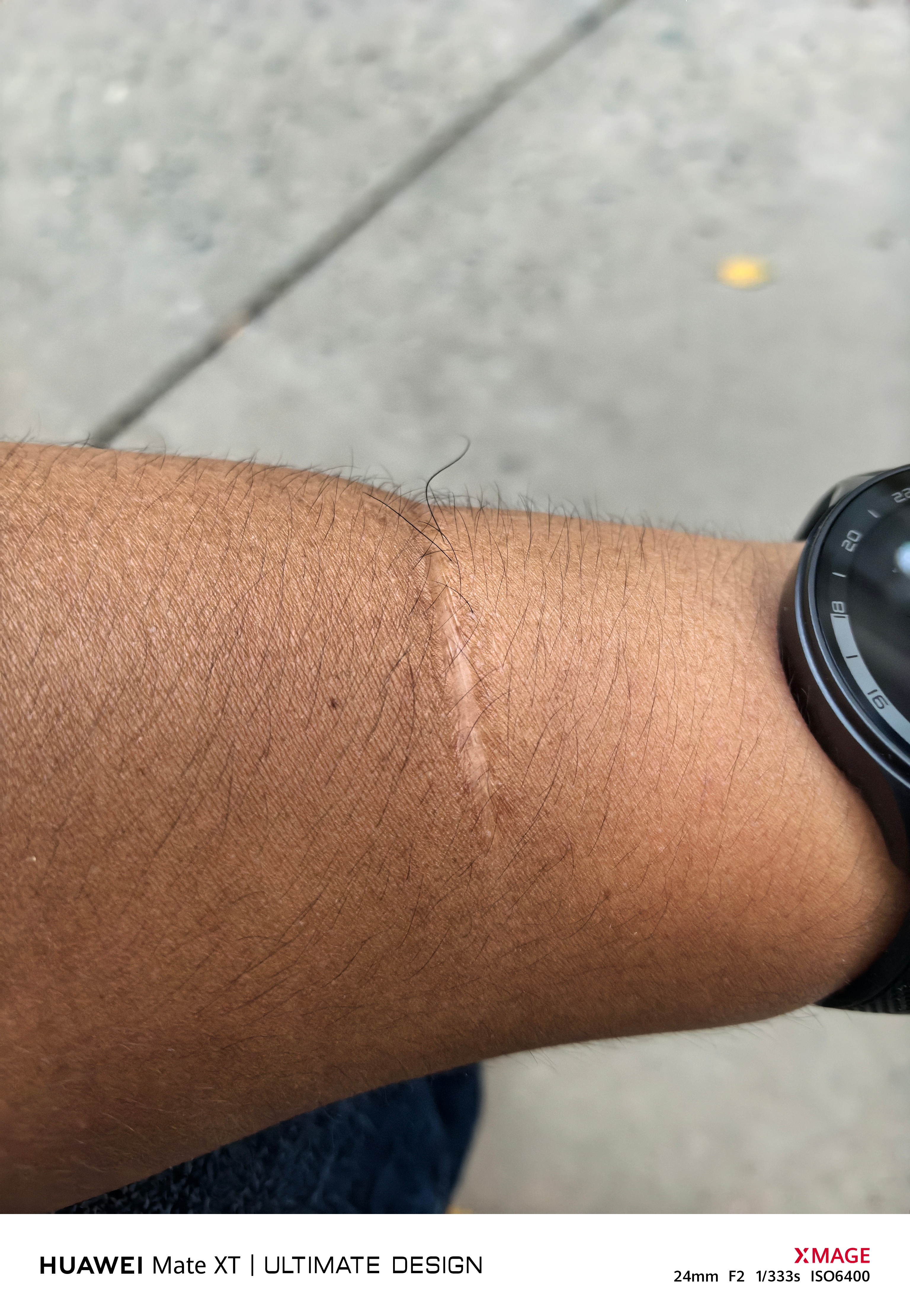 我胳膊上这伤,就是一个天天身上带着刀的人干的