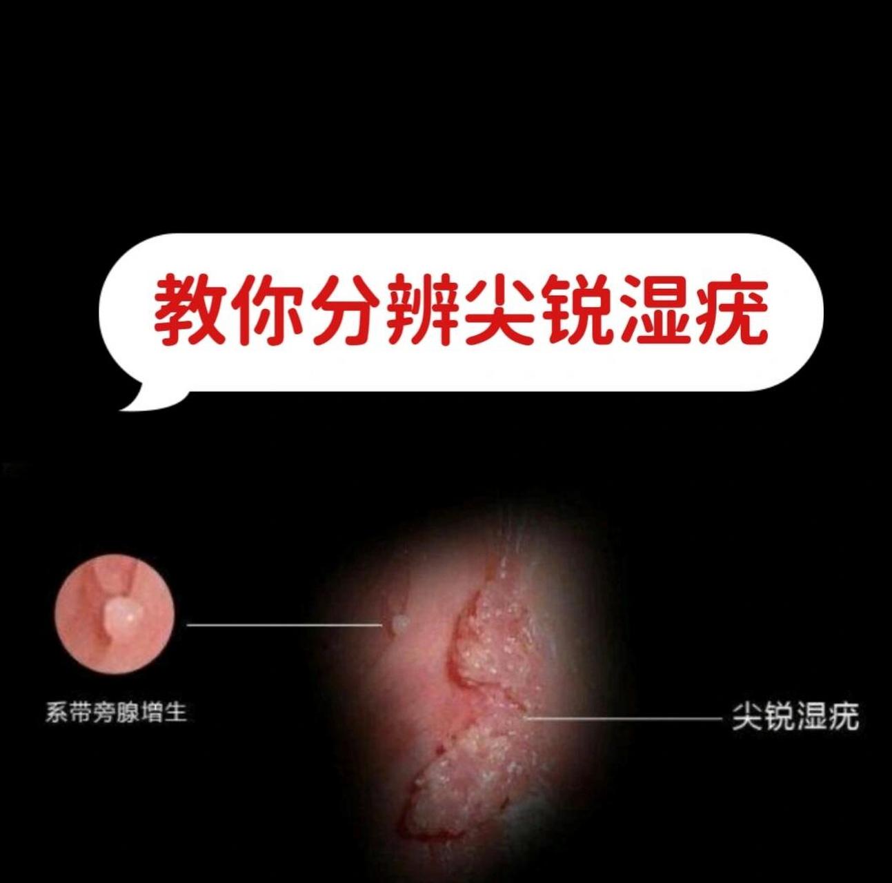 真假分辨尖锐湿疣