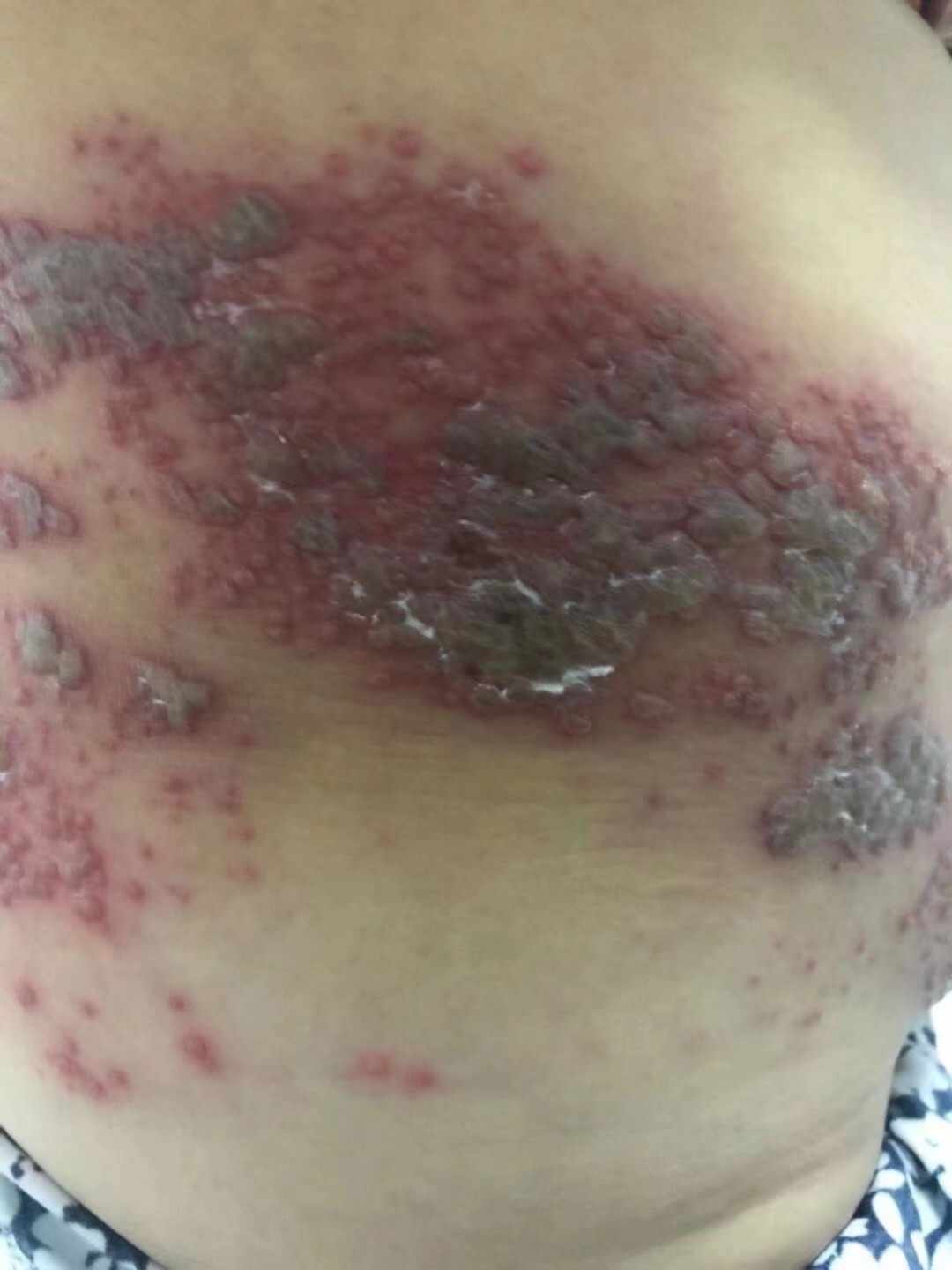 蛇盘疮在医学上由被称为带状疱疹,民间称其为蜘蛛疮,中医学上称它为缠