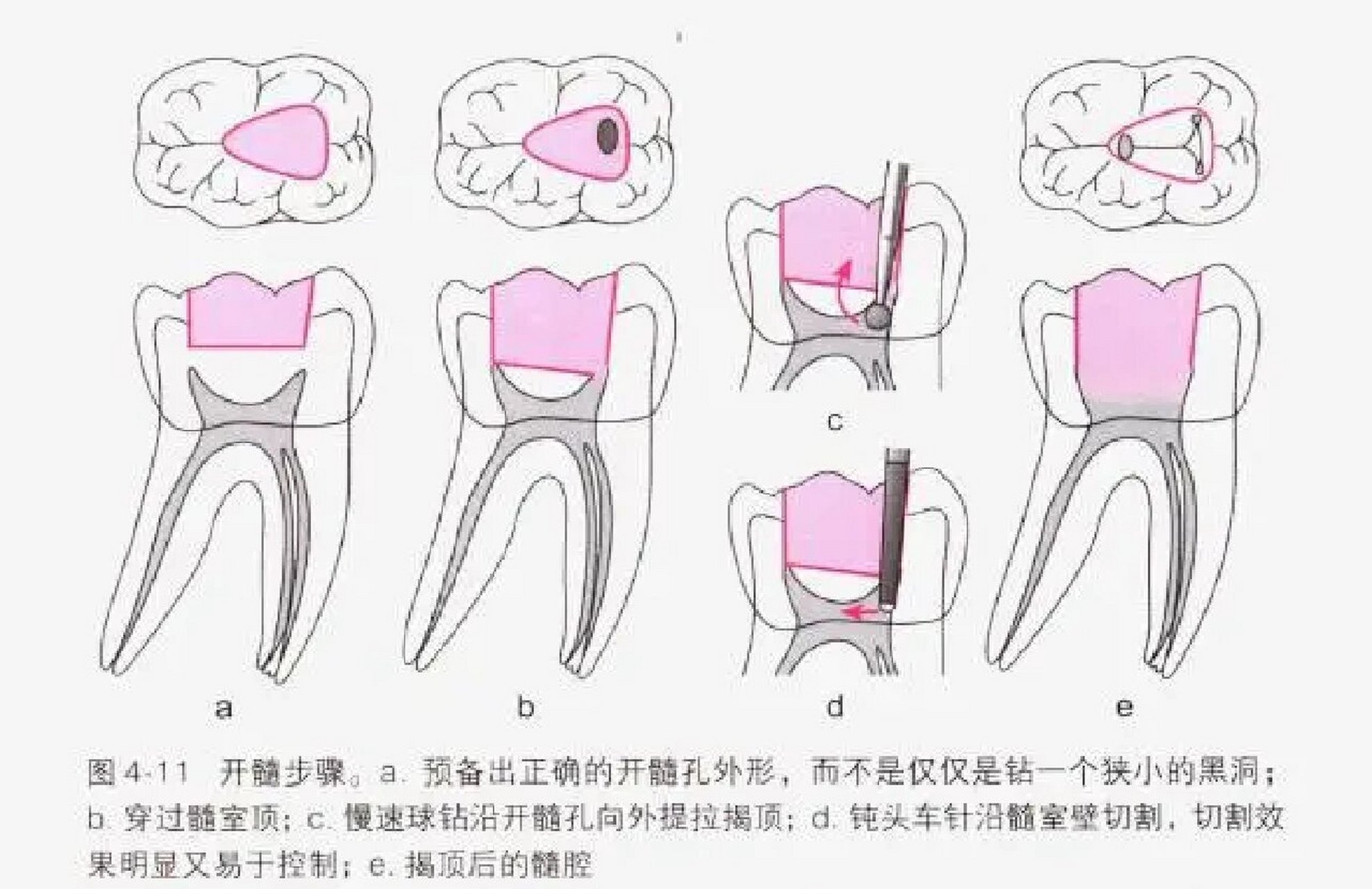 口腔开髓位置图图片