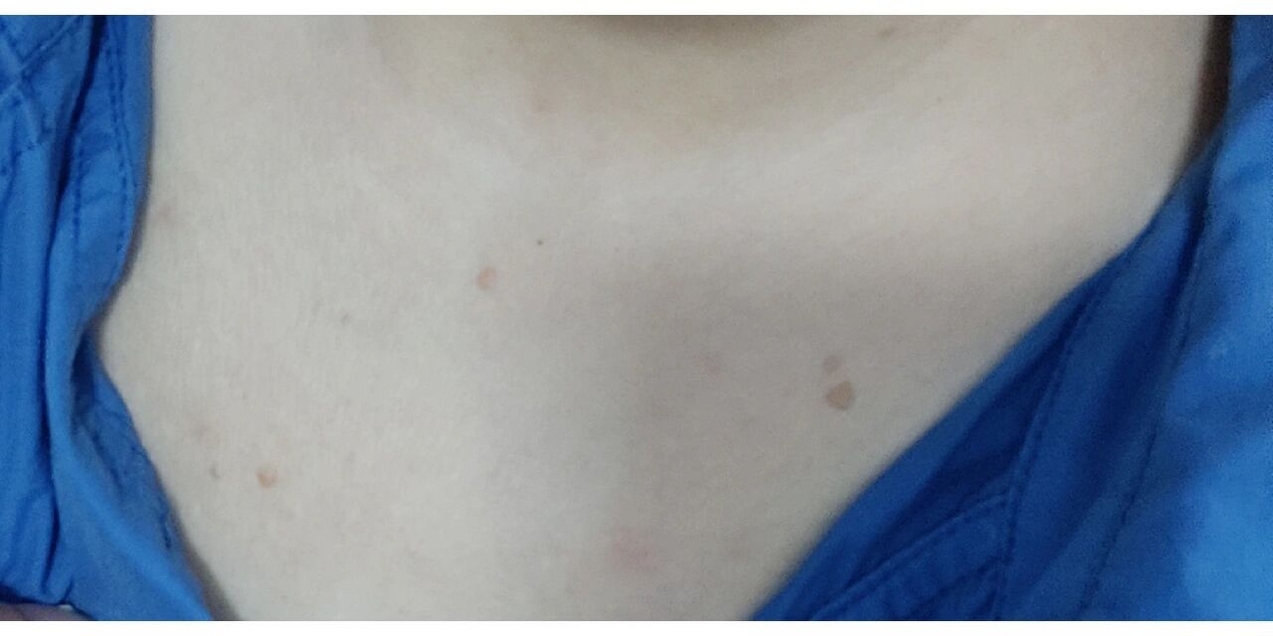 背后长了痘痘手给挤了,手又摸着背,痘痘然后就变成了扁平疣!