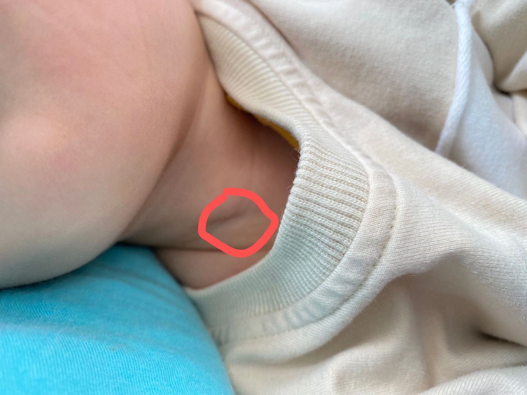 幼儿鳃裂瘘最佳手术时间 小儿16个月,先天鳃裂瘘,在北京儿研所看的说