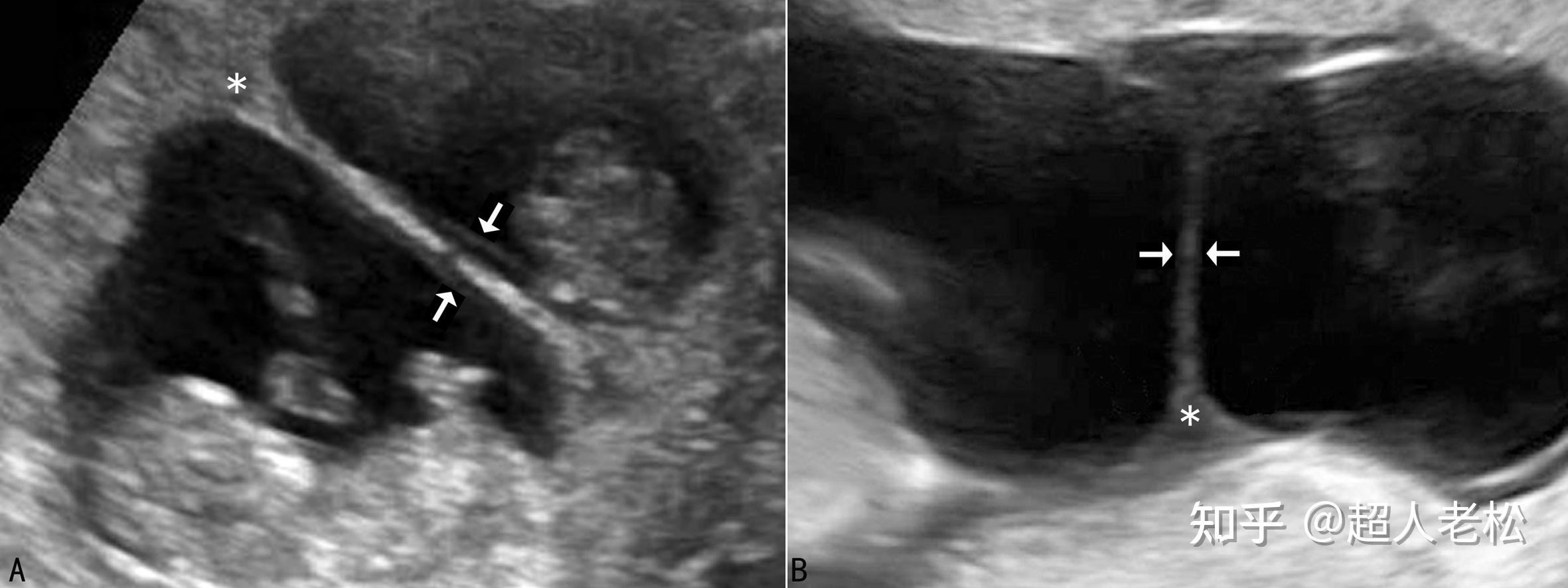 明明白白做超声225不同类型多胎妊娠超声检查