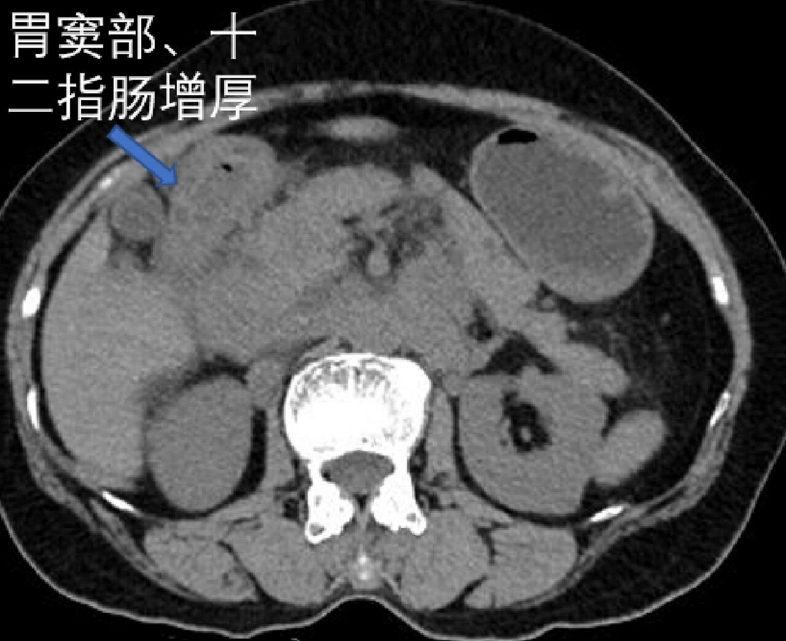 胃窦壁增厚图片