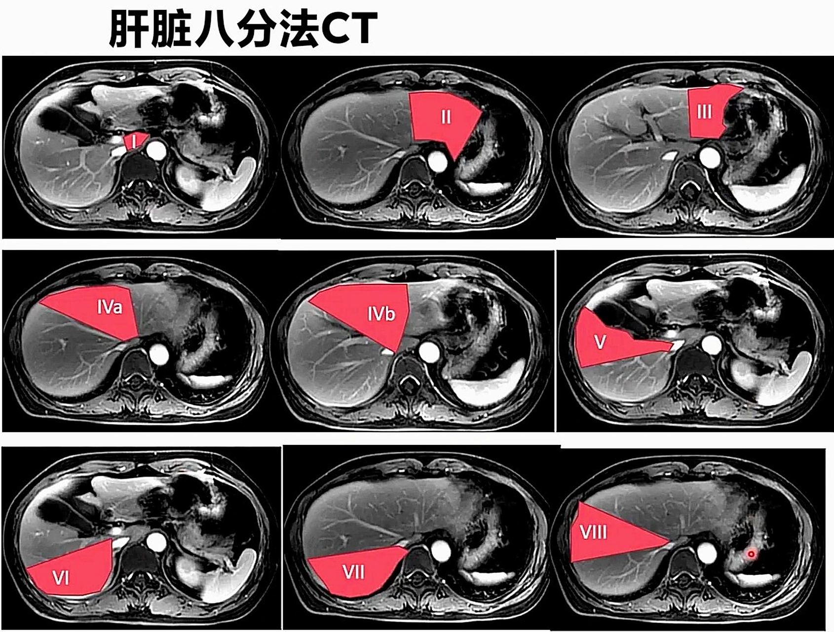 肝脏分段口诀与ct 追踪肝静脉,尾叶单独记 肝中静脉分左右 肝右静脉分