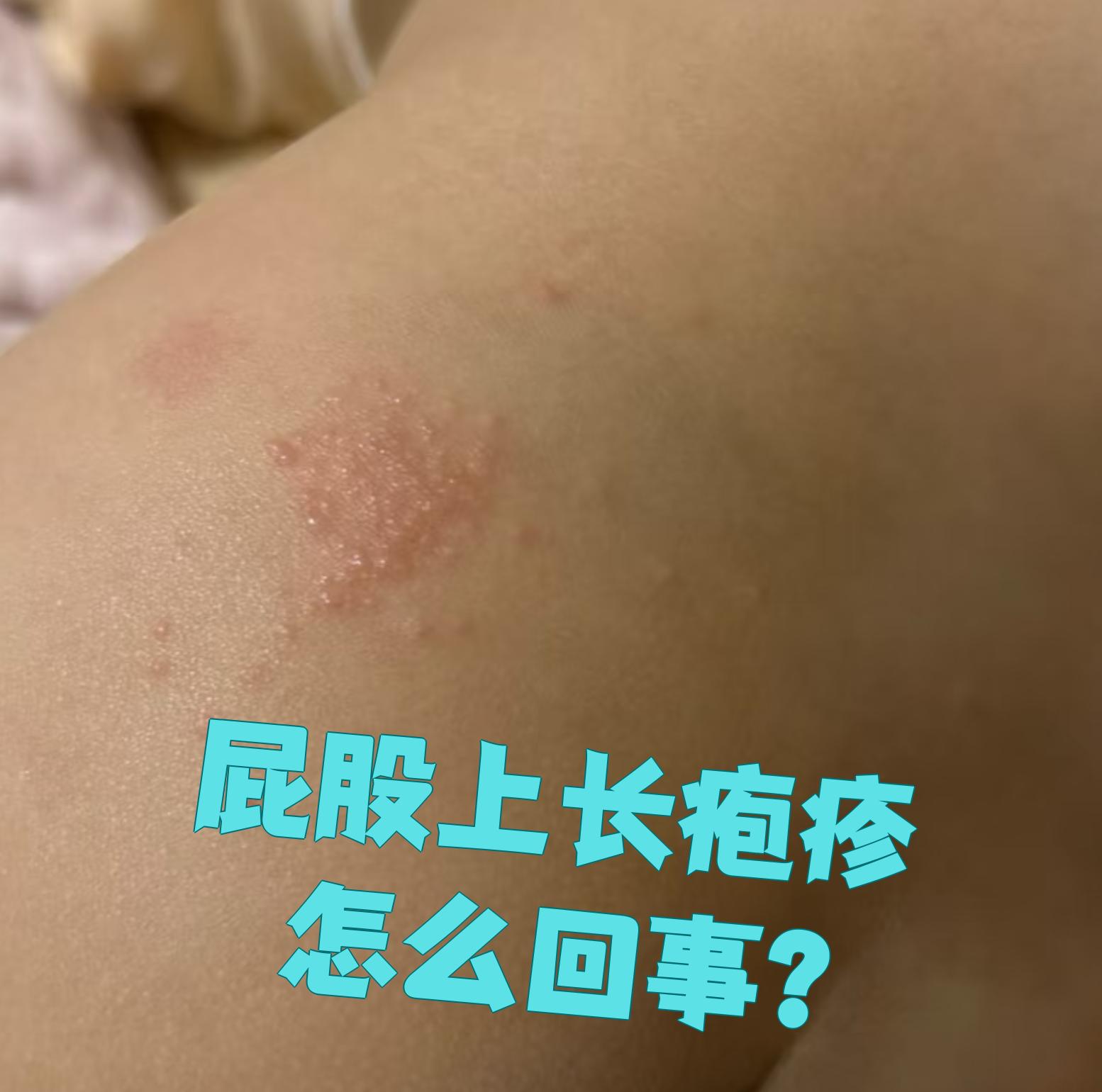 屁股奇痒无比是因为什么原因百科在线 屁股奇痒无比是因为什么原因百科在线