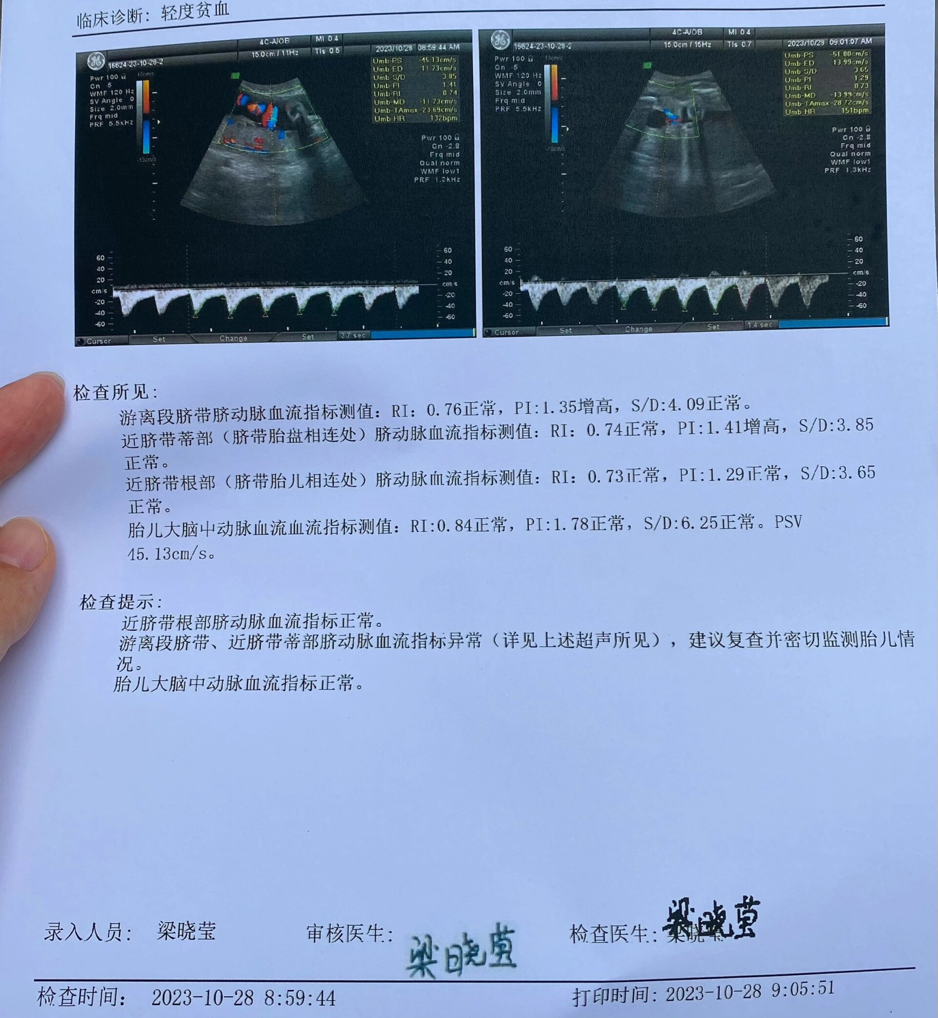 脐动脉血流高