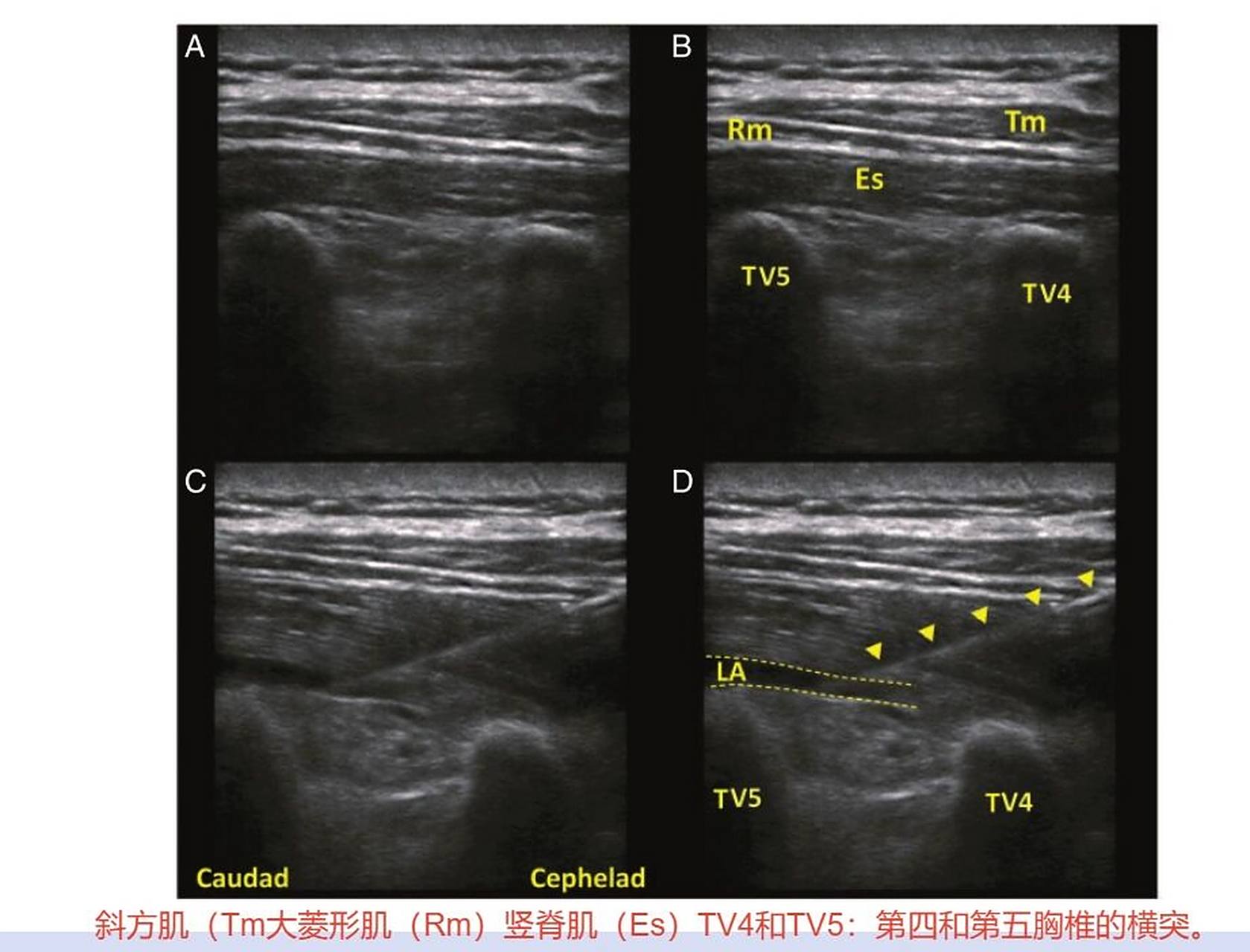 麻醉笔记|超声引导下竖脊肌平面阻滞 竖脊肌群是一个广义,较难严格