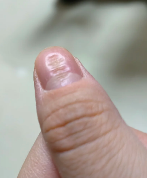 指甲上突然出现一条凸起的横纹,可能是正常情况,也可能和缺锌,受伤