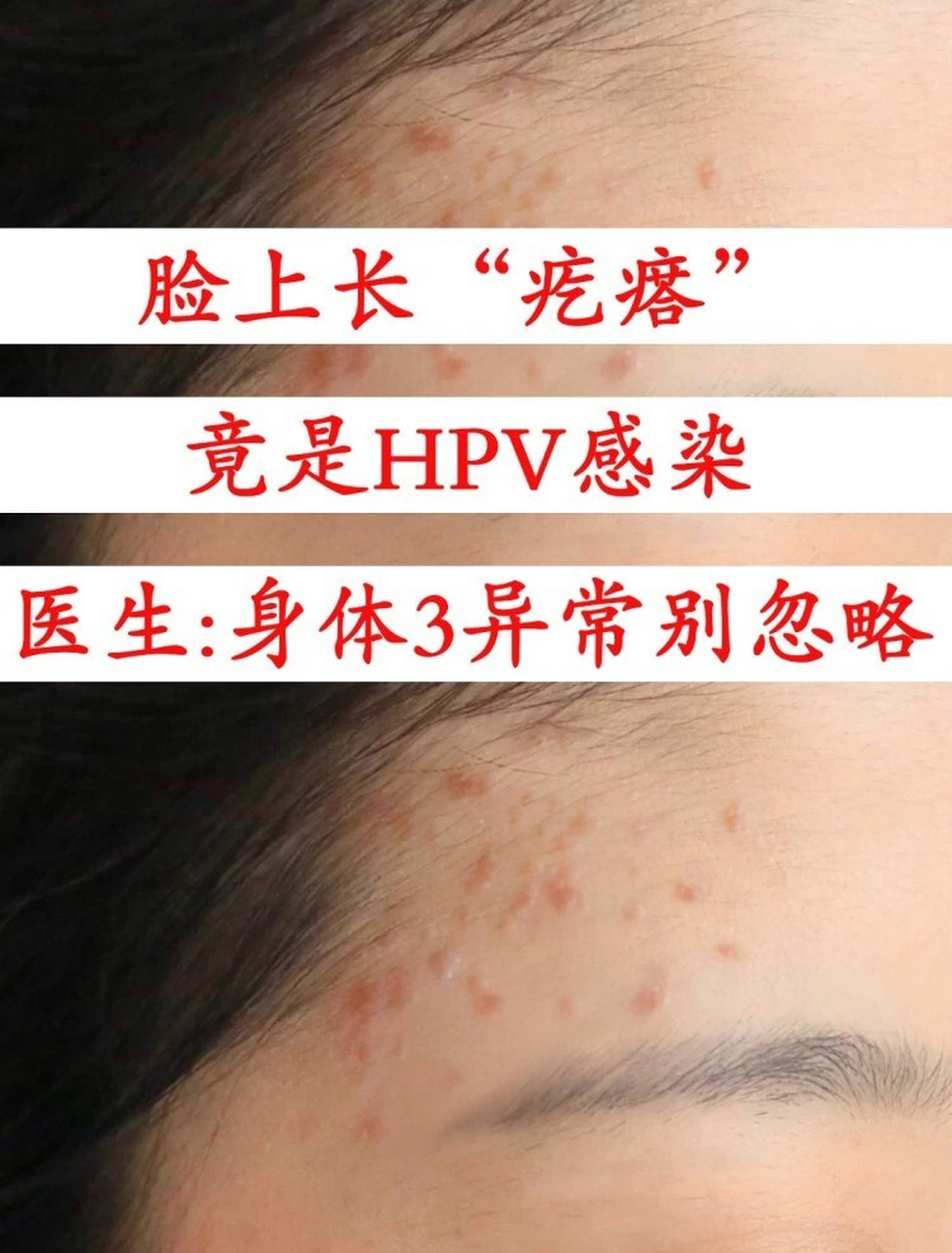 hpv感染面部图片