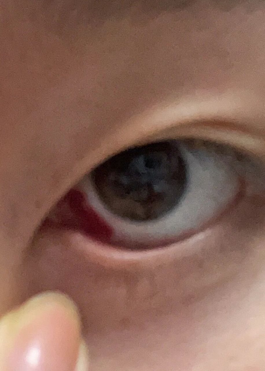 吐到眼睛充血了 吓死了 我应该感染的北京毒株 真难受啊啊啊