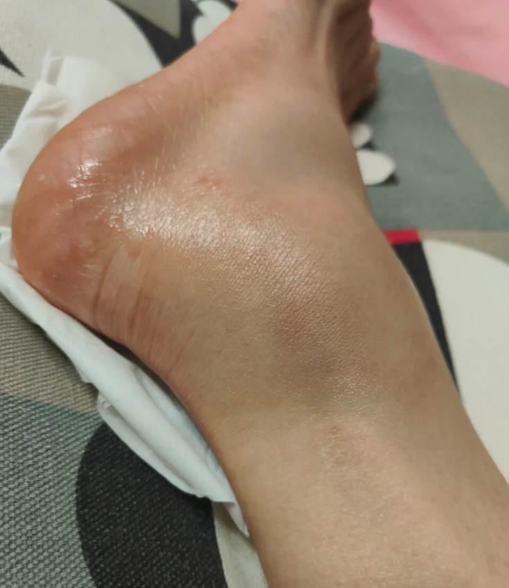 脚崴了脚侧面鼓个包,常见原因有软组织损伤,炎症反应,关节积液,血肿