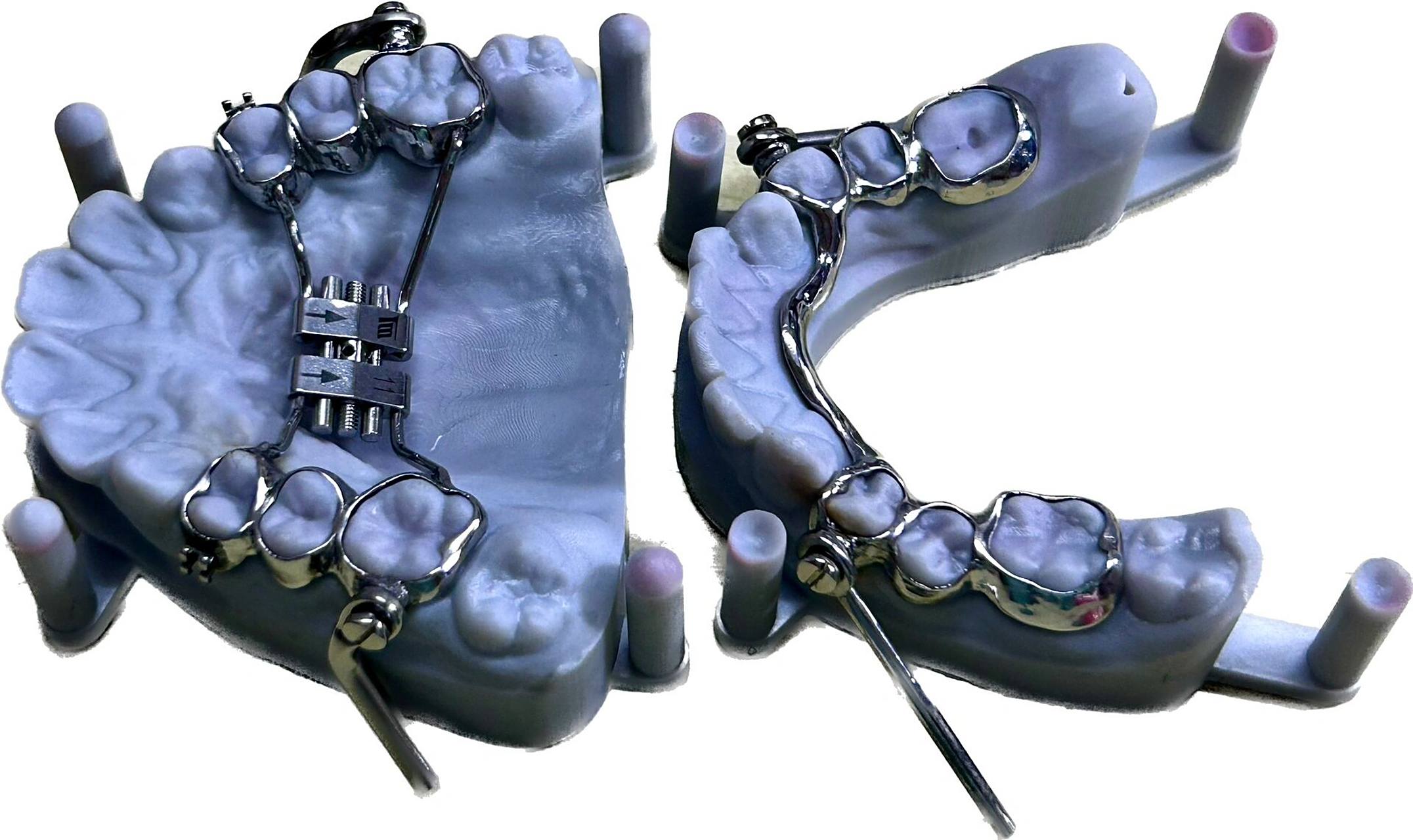 herbst 咬颌前移器(导下颌向前) herbst矫治器,是一种固定的功能性