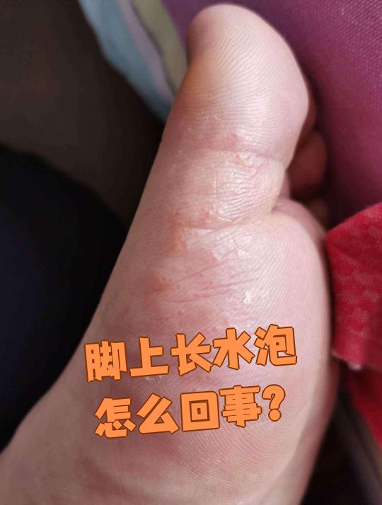 脚上长水泡怎么回事?